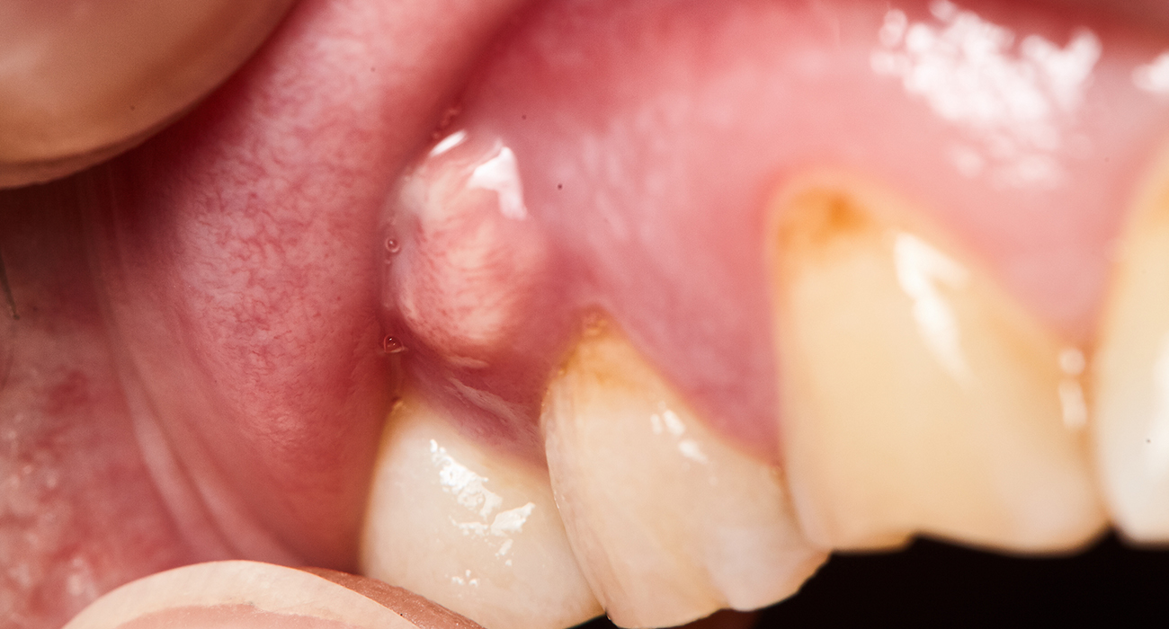 Emergency Dental Service Columbus close up of persons mouth showing an abscess on the gums