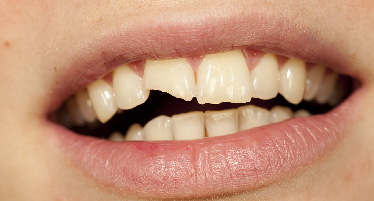 Emergency Dentist 24/7 Schaumburg close up of persons mouth showing a cracked tooth