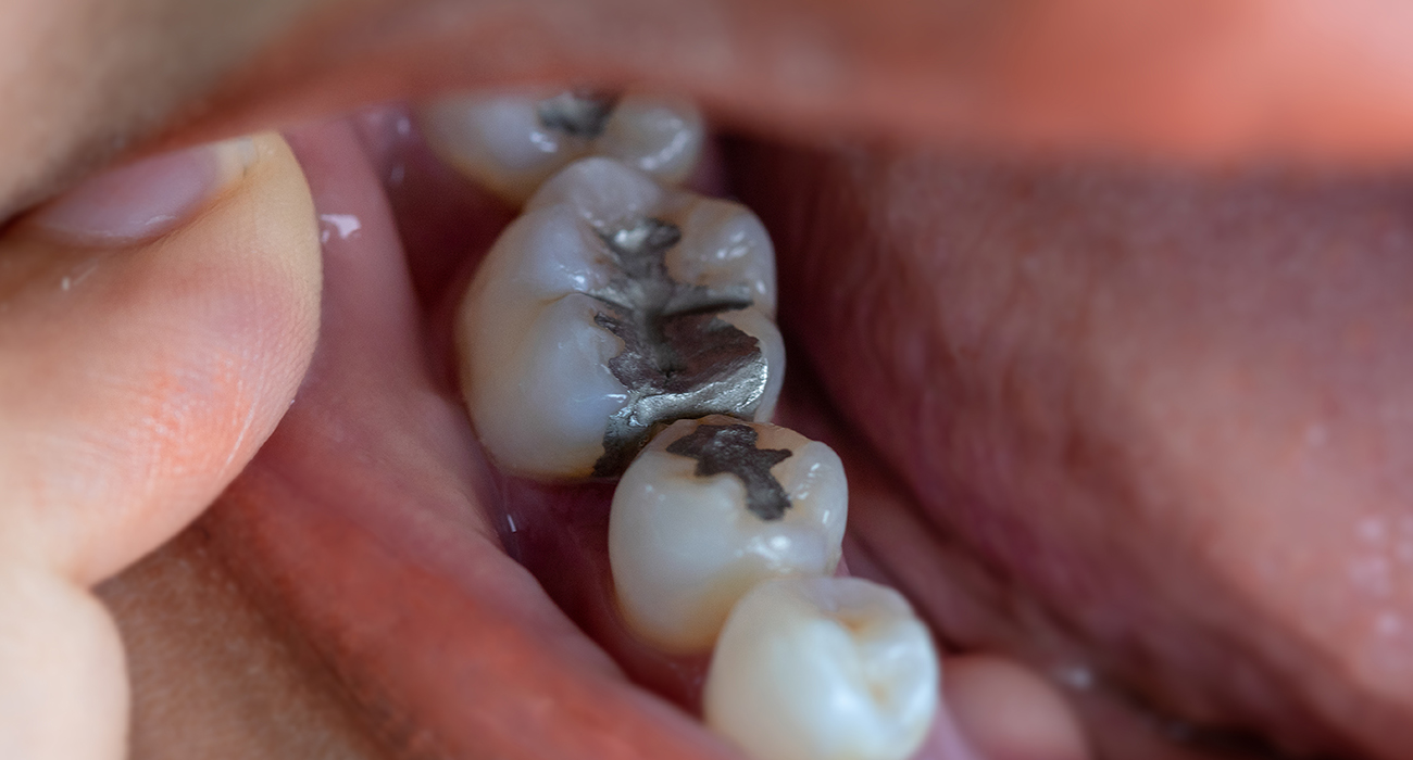 Emergency Dental Services Morton Grove close up of persons mouth showing fillings in their teeth