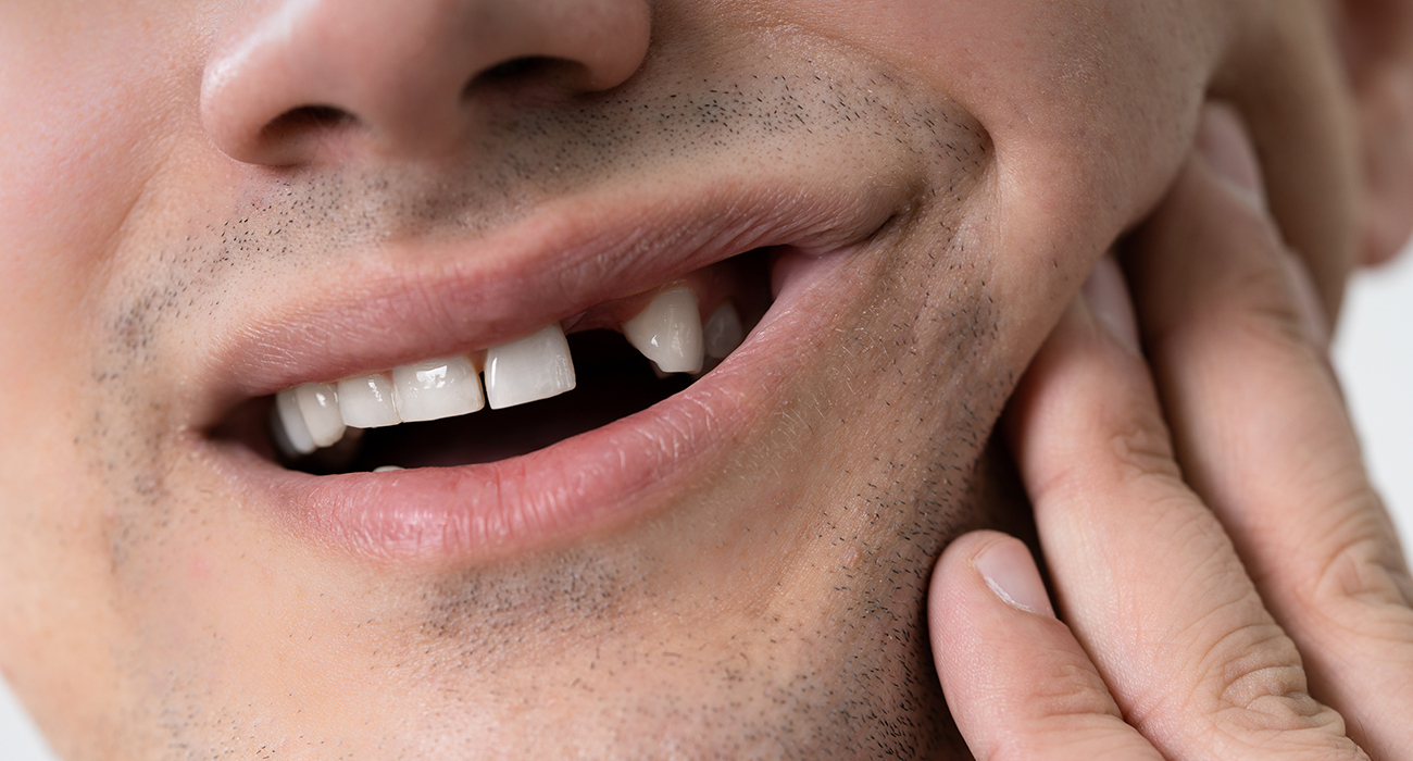 Dentist Emergency Buffalo Grove close up of persons mouth showing missing tooth