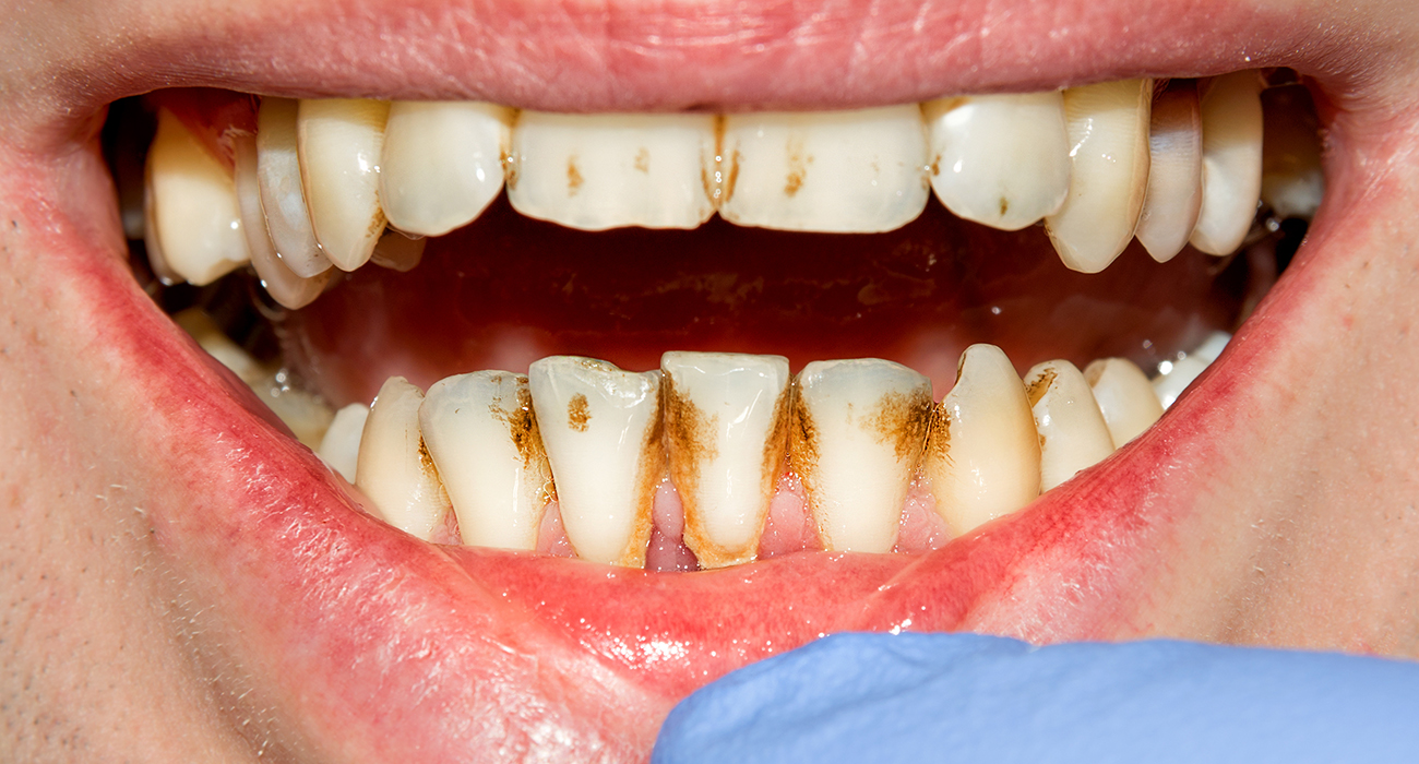 Dental Emergency Peoria close up of persons mouth with plaque and other damages from not caring for their teeth