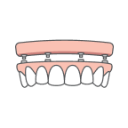 Implant-Retained Dentures