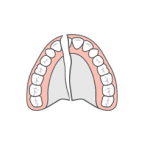 Full Dentures
