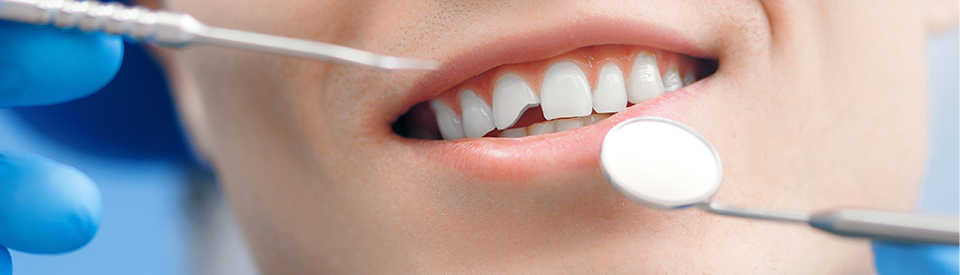 Handle a Cracked or Broken Tooth