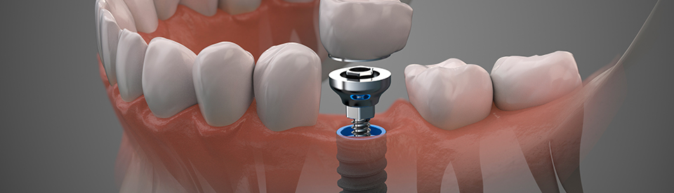 Dental Implant 3d Model