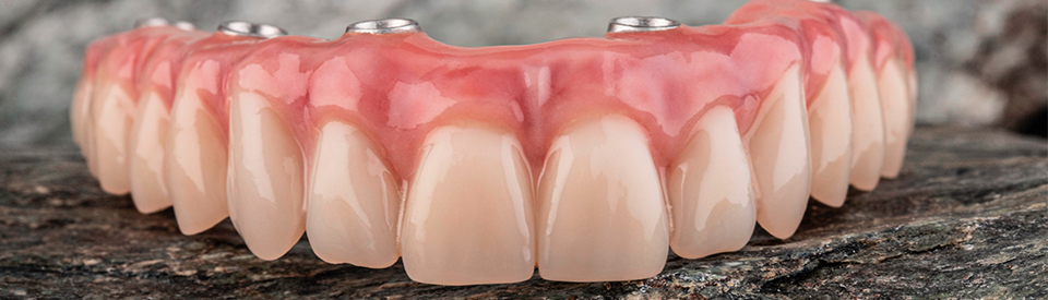 Benefits of Dental Implants