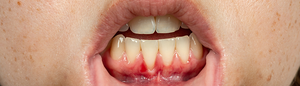 Gum Recession Treatment