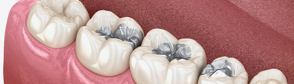 What are Amalgam Fillings