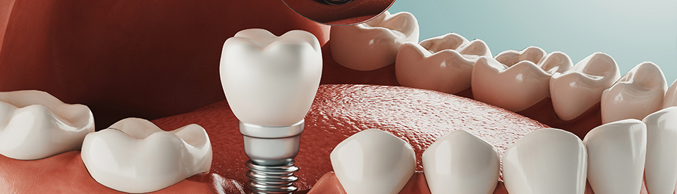 Dental Implants And Dentures