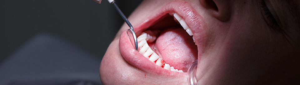 Symptoms of Periodontal Disease