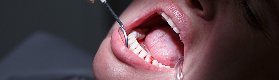 periodontal disease emergency dental service