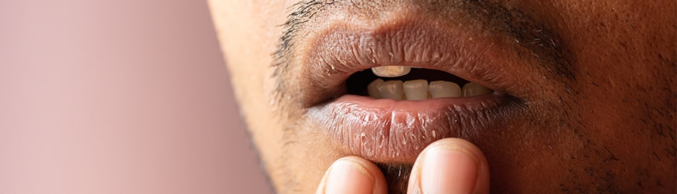 man with dry mouth and lips