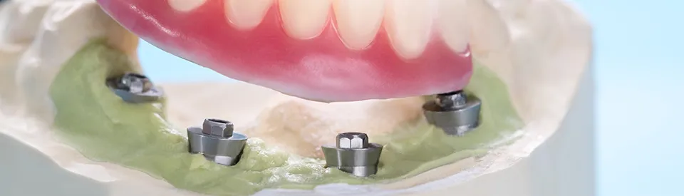 ocerdenture piece lined up with bracket