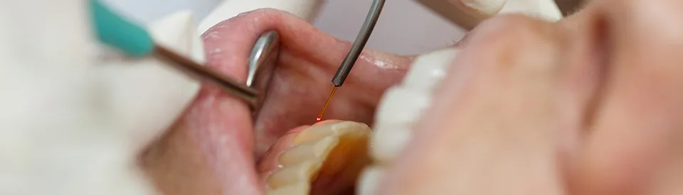 laser procedure  performed on teeth