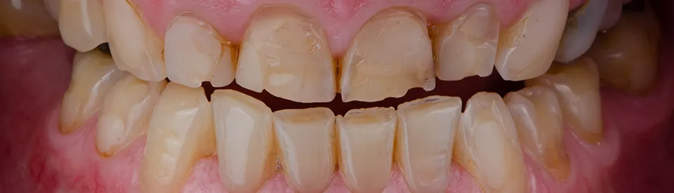 yellowed and jagged teeth
