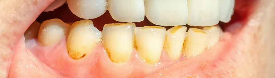 teeth with plaque