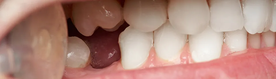 missing tooth in mouth