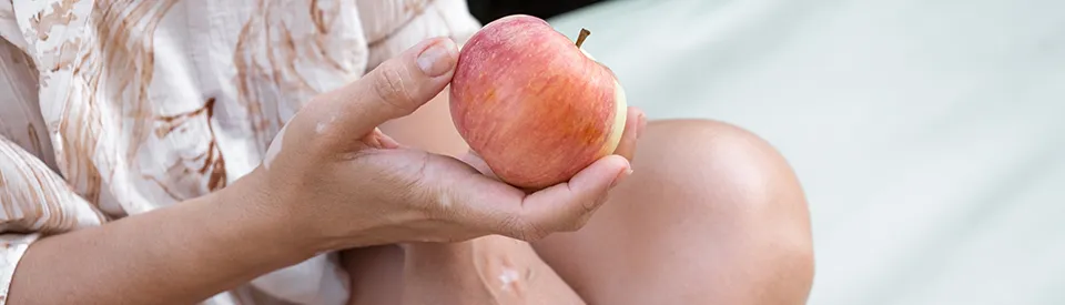 woman with vitiligo holding apple