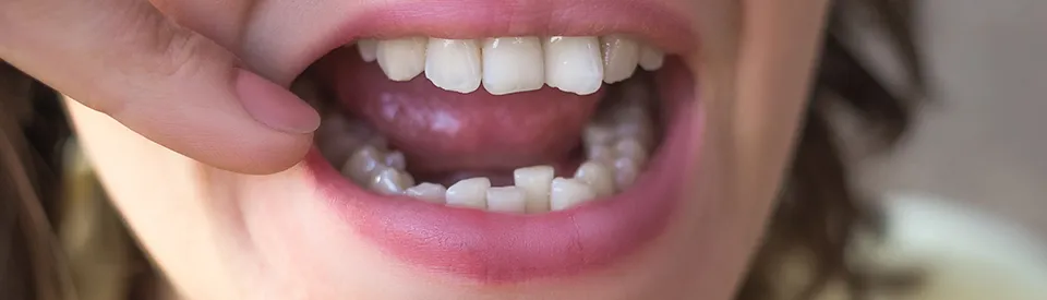 girl showing overcrowded teeth inmouth