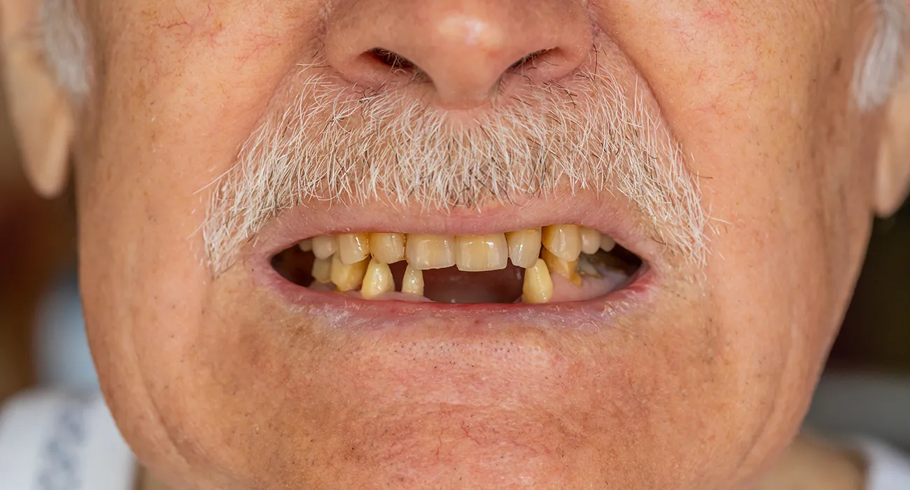 elderly man with bad teeth