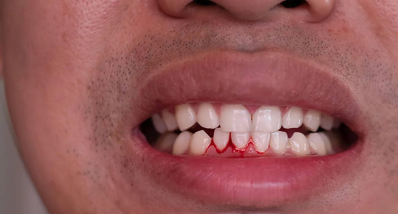 gums bleeding in mouth