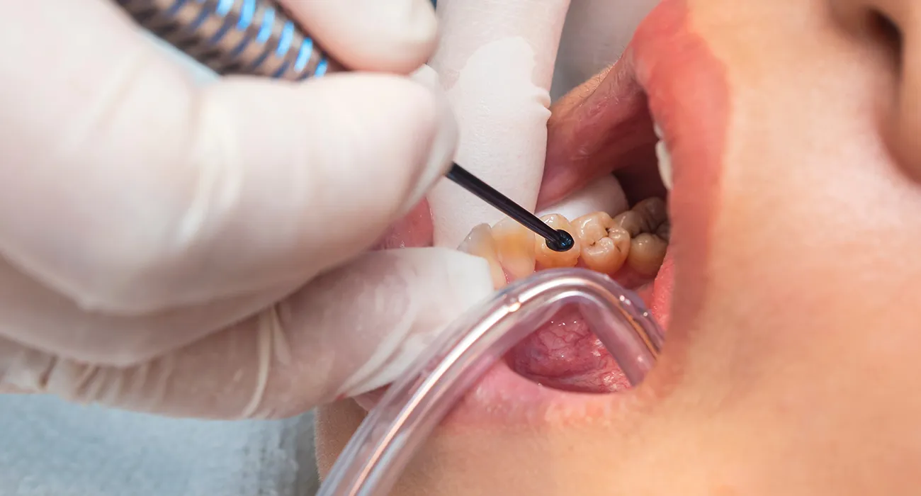 dentist inspecting mouth with cavities