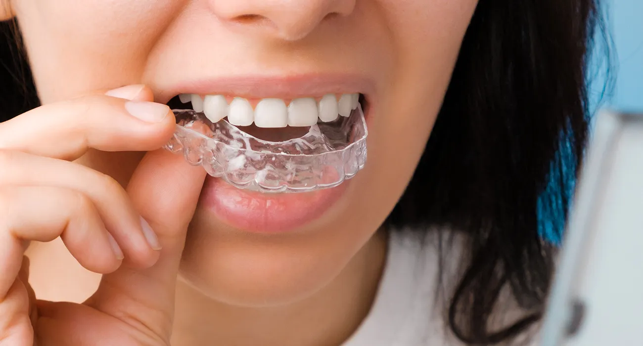 woman inserting clear aligner into mouth