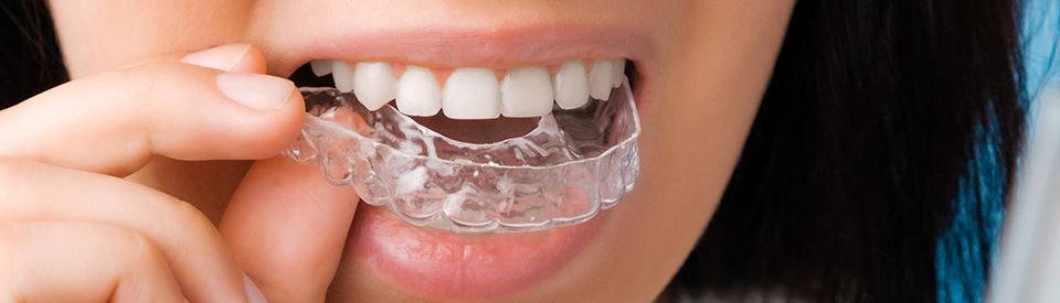 Dental Aligners