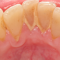 calculus teeth