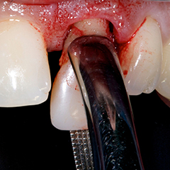 tooth extraction