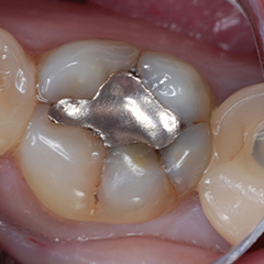 fillings