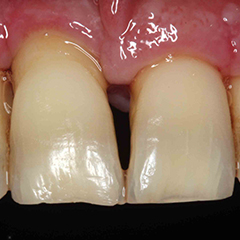 periodontitis