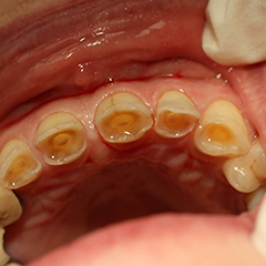 tooth abrasion