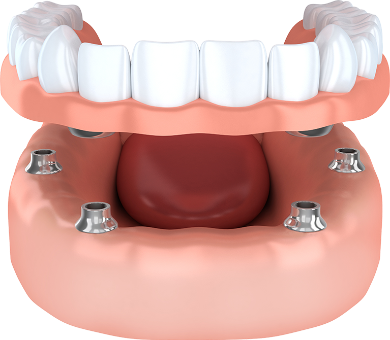 denture type pic