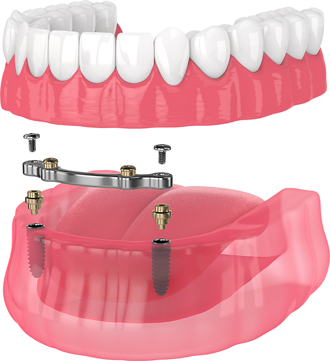 denture type pic