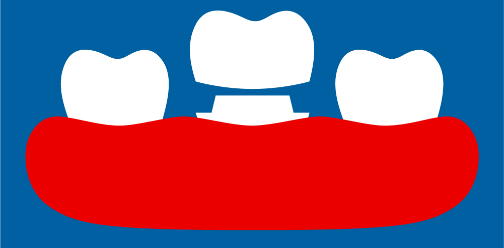 dental crowns